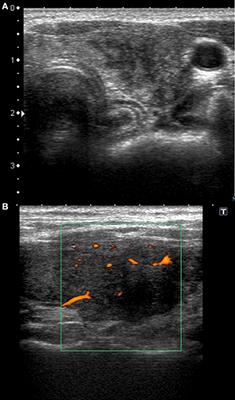 Sonographic Pattern of Subacute Thyroiditis Is HLA-Dependent